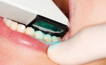 Ellipse Dentale - Empreintes dentaires numériques