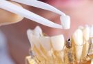 Ellipse Dentale - Implants Conjointes