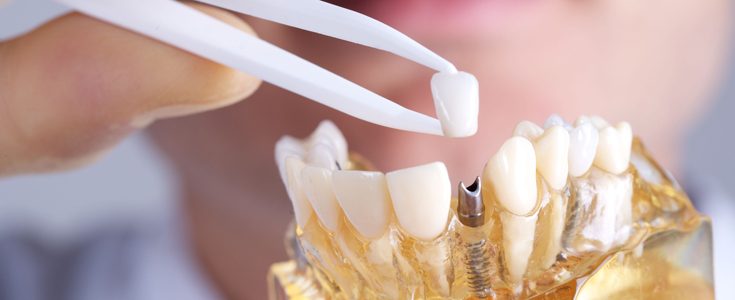 Ellipse Dentale - Implants Conjointes
