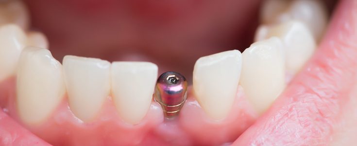 Ellipse Dentale - Implants Dentaires
